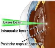 Yag Capsulotomy